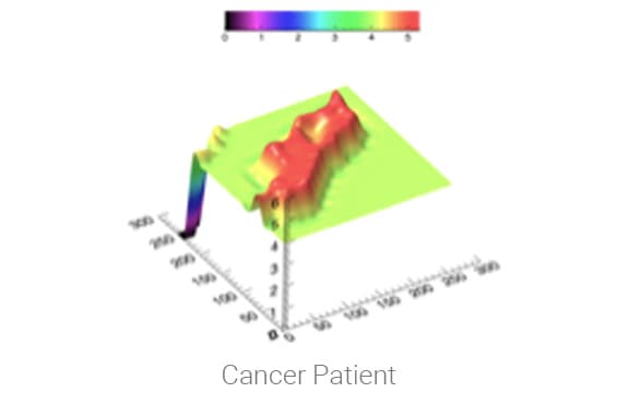Cancer Patient 3D surface plot results
