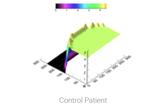 Control Patient 3D surface plot results